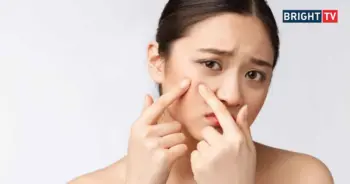 รักษาสิวให้ถูกวิธี-เริ่มยังไงดี-รวมแนวทางดูแลผิวและรักษาสิวกับหมอผิวหนัง