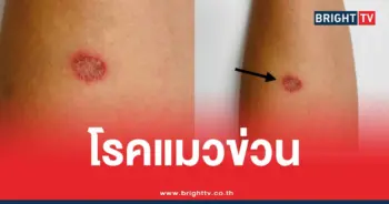 โรคแมวข่วน