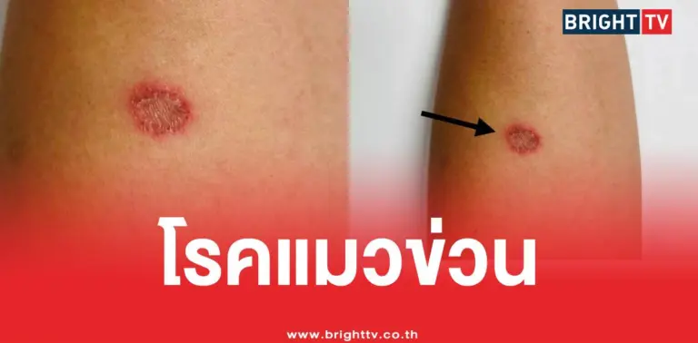 โรคแมวข่วน