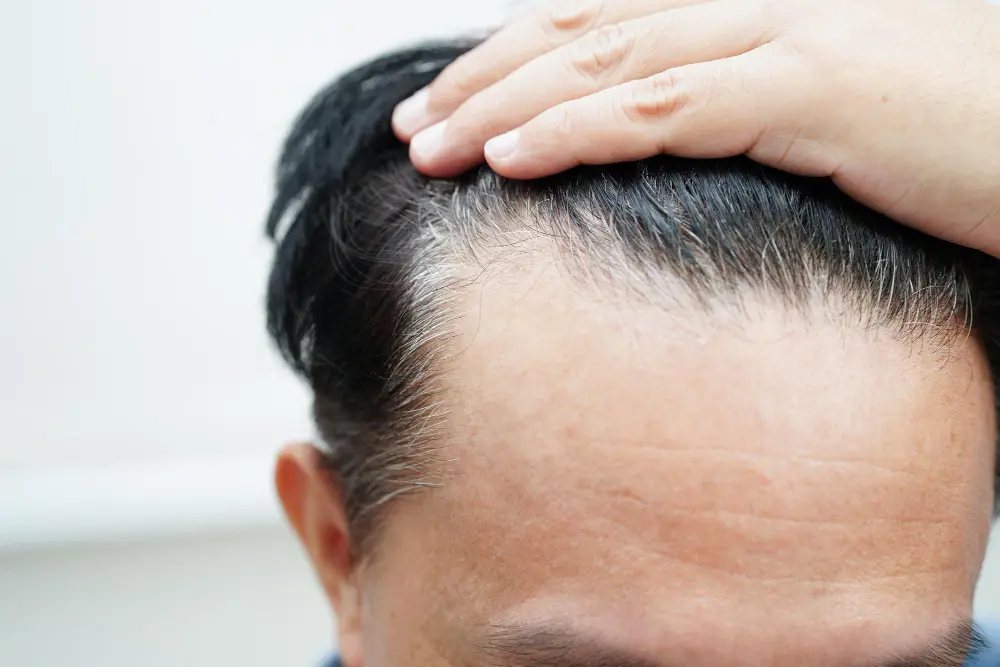thin-hair
